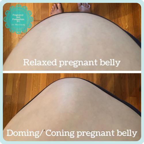 Diastasis Recti During Pregnancy Pregnancy And Postpartum Pt